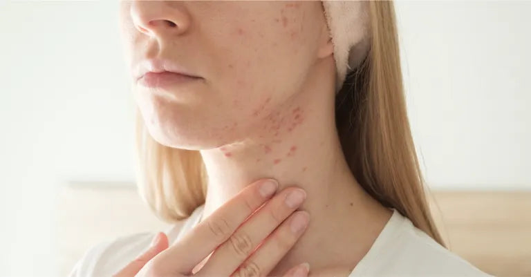 PCOS, Hormones and Acne Beyond Skincare: What Your Face Is Trying to Tell You